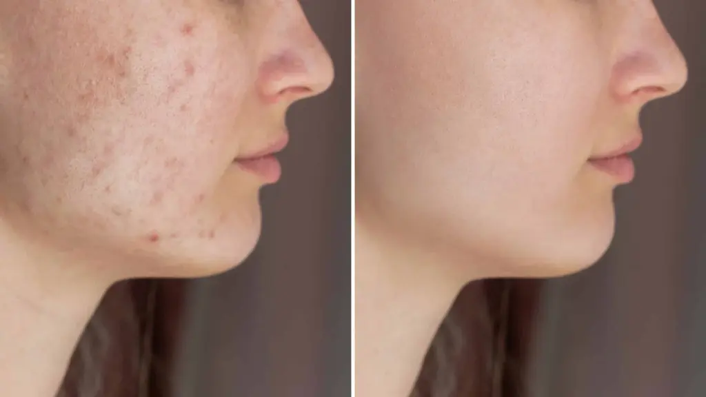 Dealt With Melasma | Aspire Aesthetics and Wellness