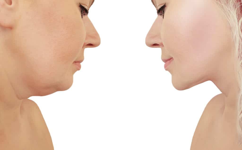 Want to Get Rid Of A Double Chin? Here Are Five Ways To Do It. 1 Double Chin | Aspire Aesthetics and Wellness