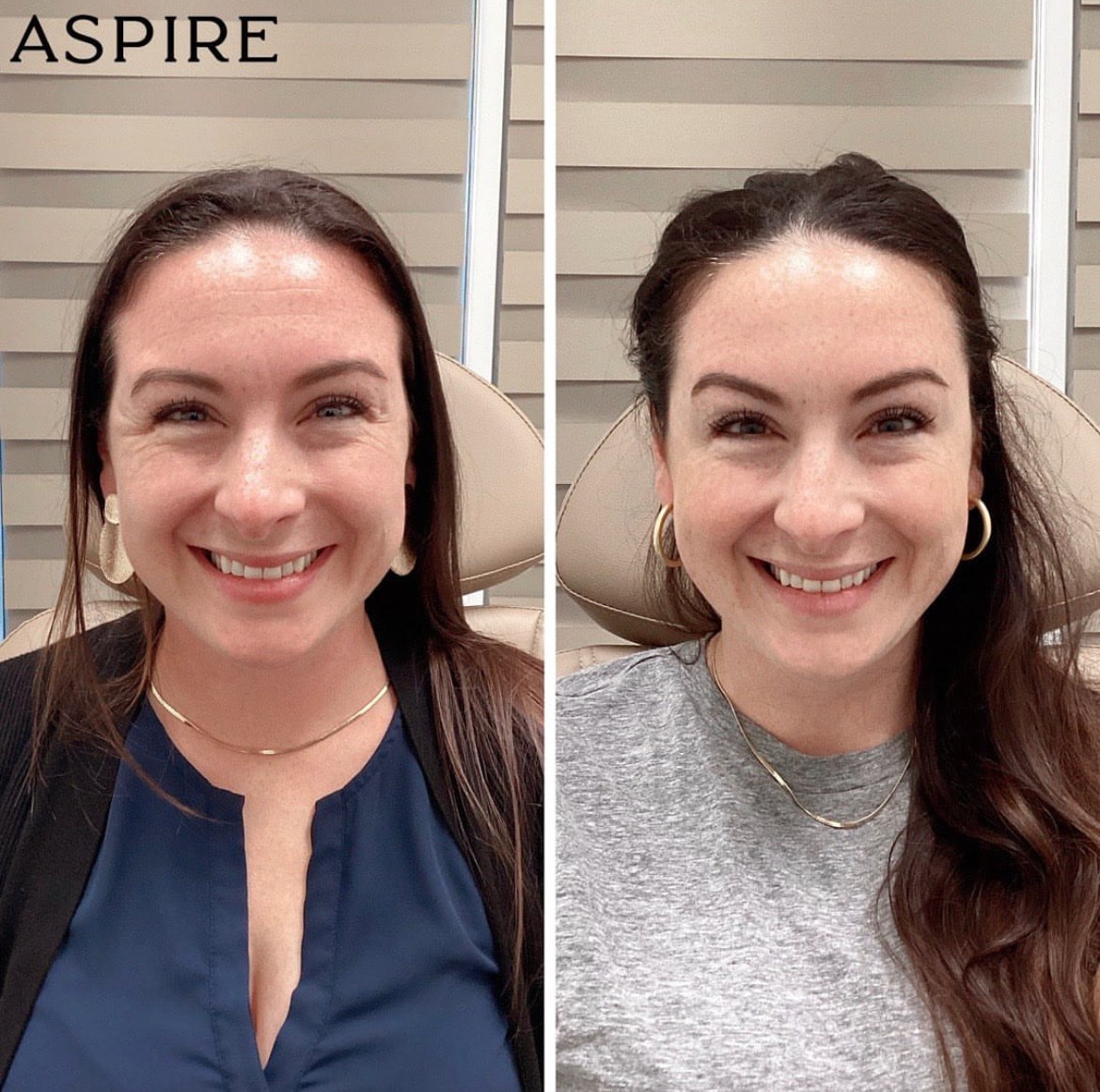 Before & After Image | Aspire Aesthetics and Wellness | Corpus Christi TX