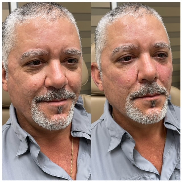Before & After Image | Aspire Aesthetics and Wellness | Corpus Christi TX