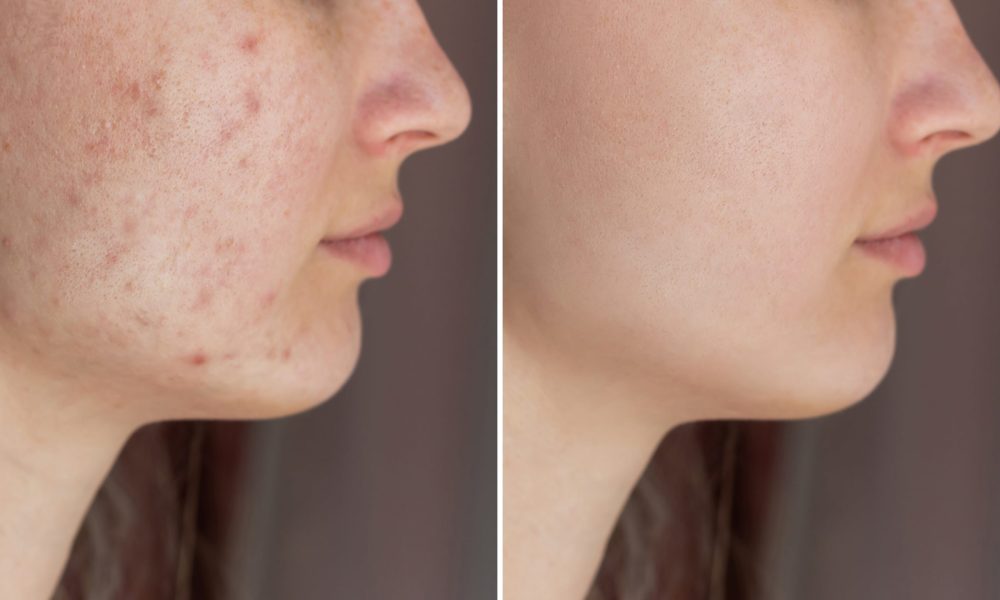 Dealt With Melasma | Aspire Aesthetics and Wellness